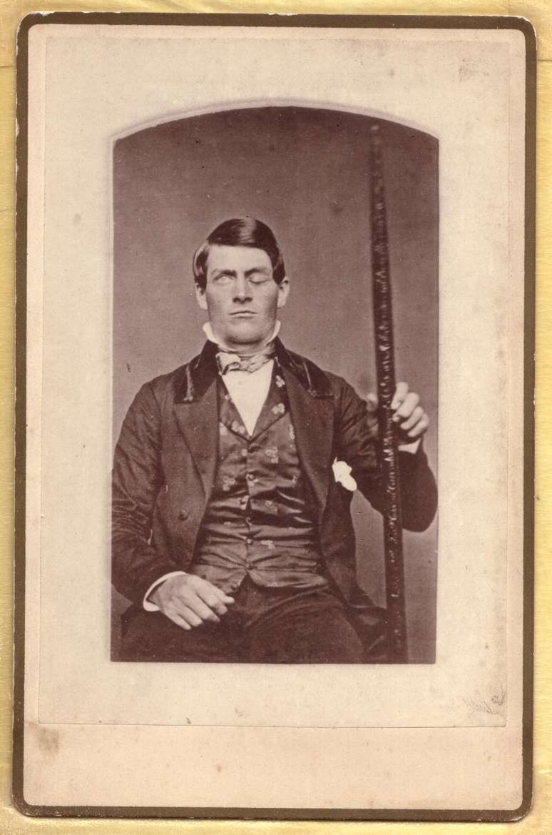 Phineas P. Gage (1823–1860) segura barra de ferro que atravessou sua cabeça