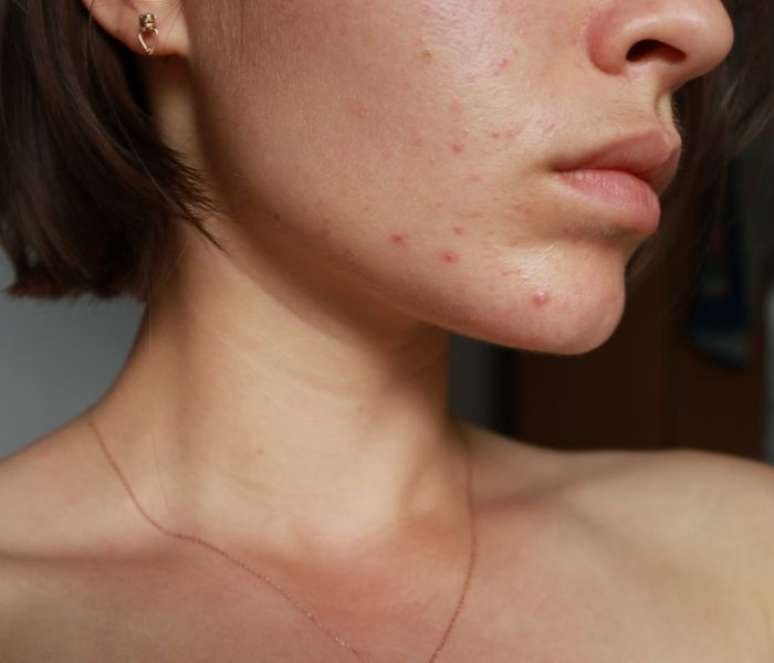 Um dos problemas na pele que o estresse pode causar é a acne – Shutterstock