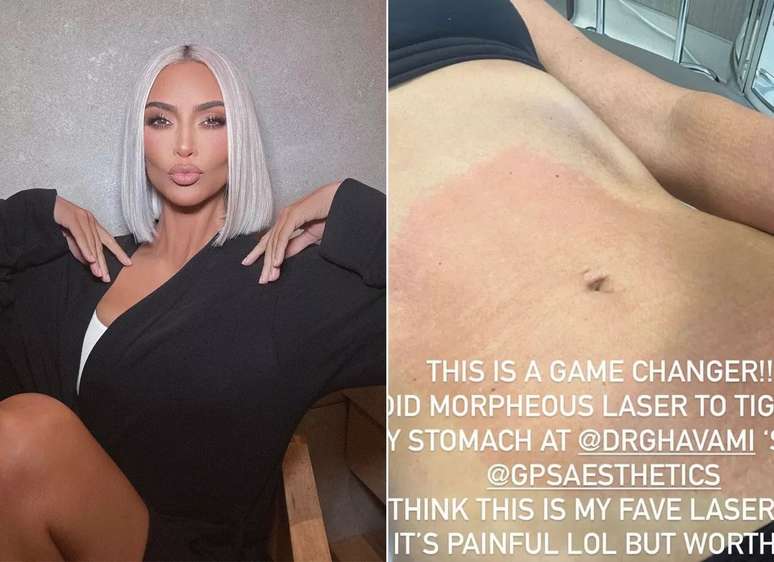 Kim Kardashian fez procedimento a laser no estômago para perder peso