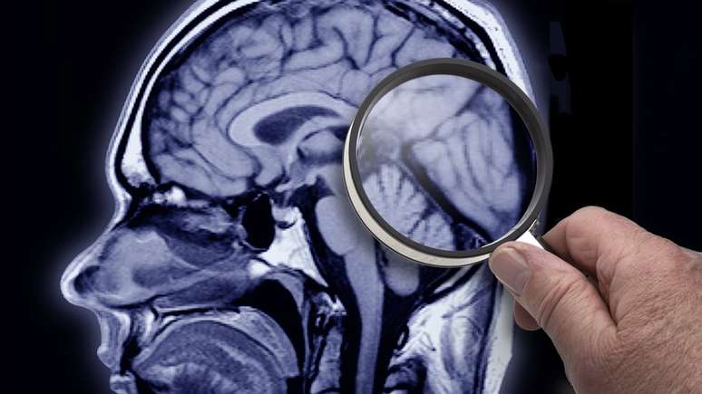 Tentativas de combater Alzheimer focam na redu&ccedil;&atilde;o do decl&iacute;nio cognitivo