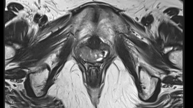 Alguns exames de imagem ajudam a diagnosticar a síndrome