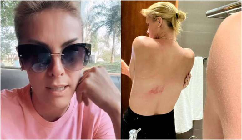 Ana Hickmann cai de cavalo e machuca as costas