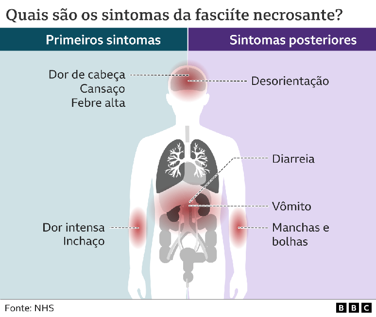 Infográfico mostra sintomas da fasciite necrosante