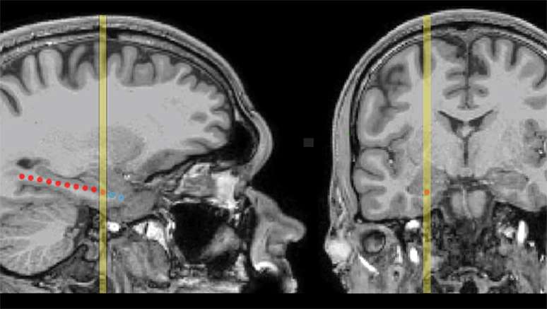 Ressonância magnética mostrando locais de eletrodos medial-temporais em um paciente representativo
