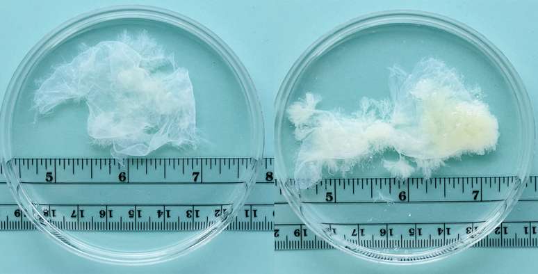 Tecido removido na oitava (esquerda) e na nona (direita) semana de gesta&ccedil;&atilde;o