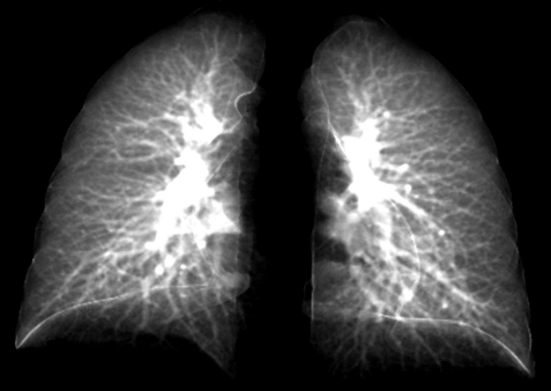 Pesquisadores criaram um modelo avançado de raio-x que pode detectar danos pulmonares em pacientes com covid longa 