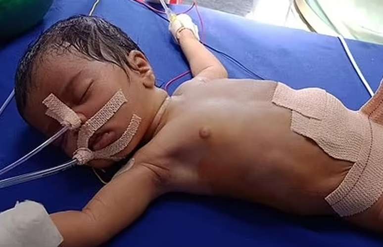 Bebê passou por cirurgia para retirada de embriões