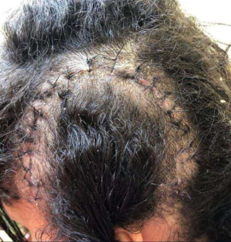 Jovem passou por uma cirurgia na cabe&ccedil;a ap&oacute;s incidente