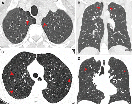 Enfisema pulmonar em (A, B) fumantes de maconha e (C, D) fumantes de tabaco.