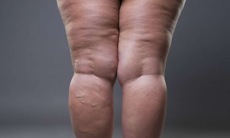 Lipedema: saiba o que causa o acúmulo de gordura no corpo