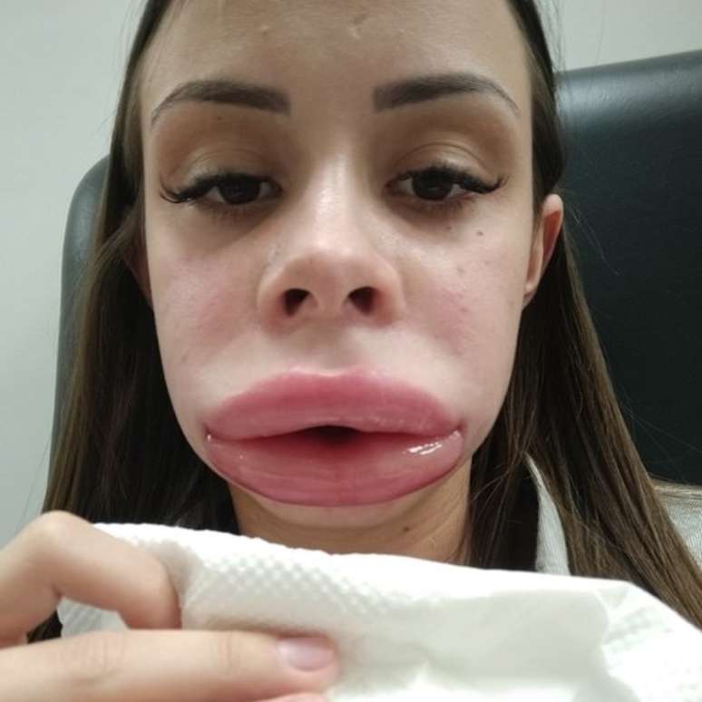 Após preenchimento labial, Pamela Andrade teve forte inchaço na boca, no rosto, nos olhos