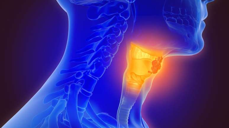 Leucoplasia gera a formação de uma placa branca na mucosa da boca ou da garganta