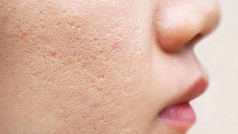 Cicatrizes de acne cuidados