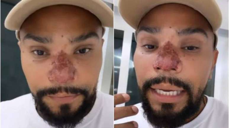 Naldo Benny compartilhou nas redes sociais que sofreu um princípio de necrose no nariz após fazer rinomodelação.