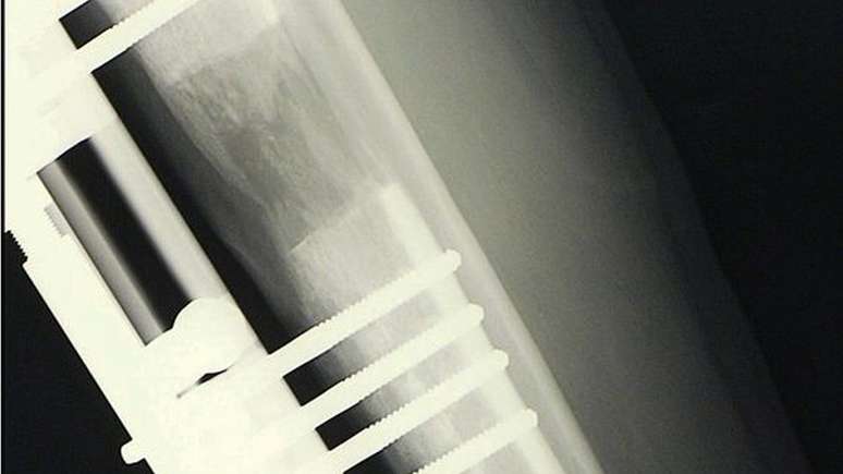 O osso, uma vez separado, come&ccedil;a a preencher o espa&ccedil;o