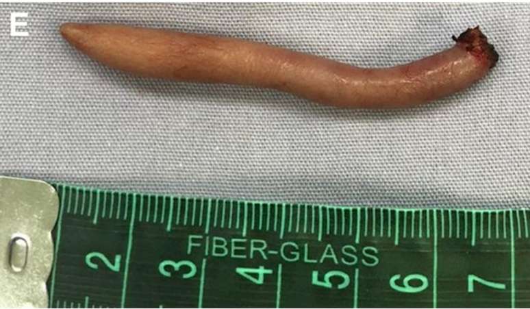 Há quatro imagens que mostram a retirada cirúrgica da cauda. A última mostra apenas a cauda, com comprimento aproximado de 6 cm.