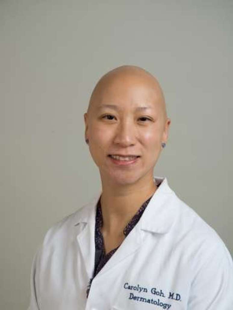 A médica Carolyn Goh tem alopecia areata