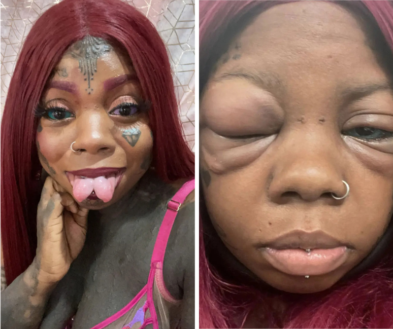 A jamaicana está acostumada a fazer modificações corporais, como bifurcação da língua e tatuagens, e compartilha seu estado de saúde através do TikTok