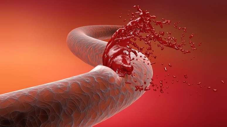 A hemofilia é uma doença hereditária que faz com que o sangue não coagule da maneira adequada