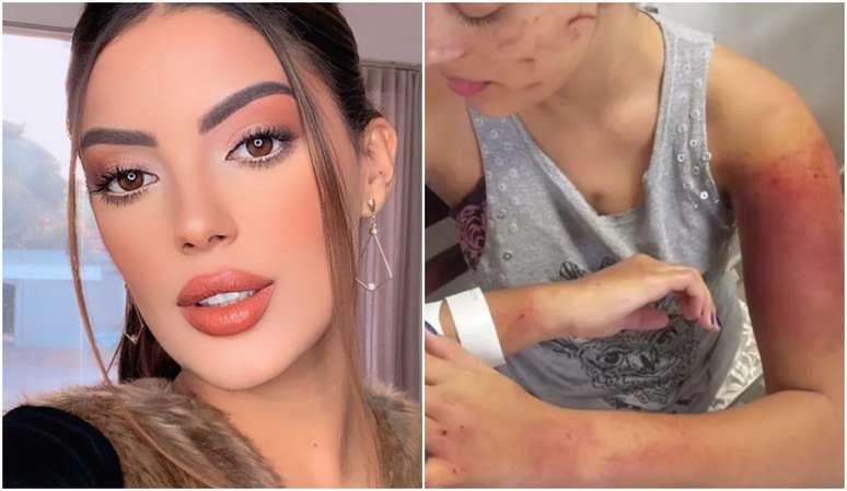 Em postagens em seu perfil no Instagram, Isabella Lacerda mostrou hematomas em várias partes do corpo.