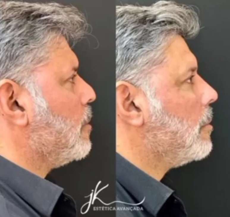 Alexandre Frota, antes e depois