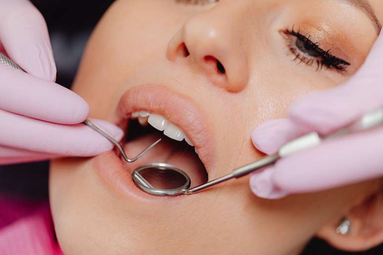 Clareamento dental exige cuidados