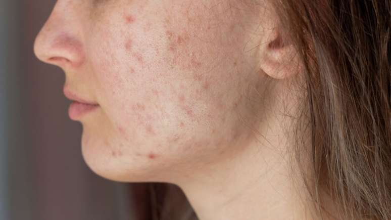 As lesões da acne adulta surge em locais como bochechas e queixo -