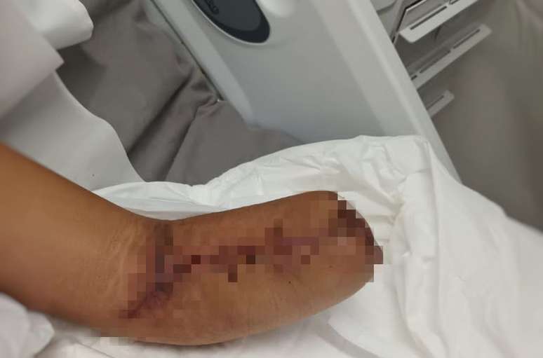 Mulher teve mão e parte do braço amputado após dar entrada em hospital