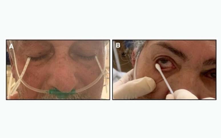  o swab conjuntival (à esquerda) e as tiras de Schirmer, empregadas em exame que avalia se o olho produz quantidade suficiente de lágrimas