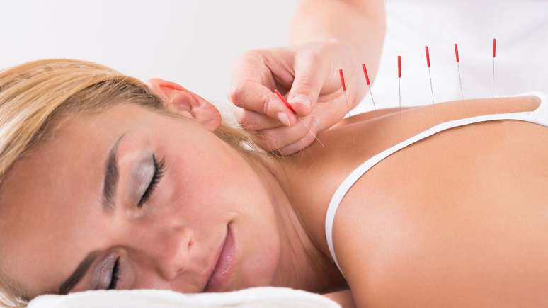 A acupuntura é uma técnica ligada à medicina chinesa que usa agulhas para estimular pontos no corpo -