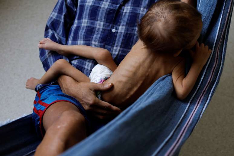 Criança yanomami de 4 anos internada em hospital de Boa Vista para tratar desnutrição