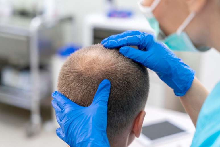 6 myths and truths about hair transplantation