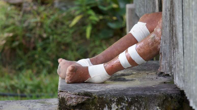 Hansen&iacute;ase pode causar marcas na pele e atrofia nos membros