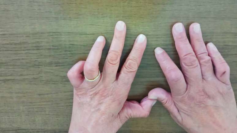 M&atilde;os de Maria Catelli foram atrofiadas pela hansen&iacute;ase