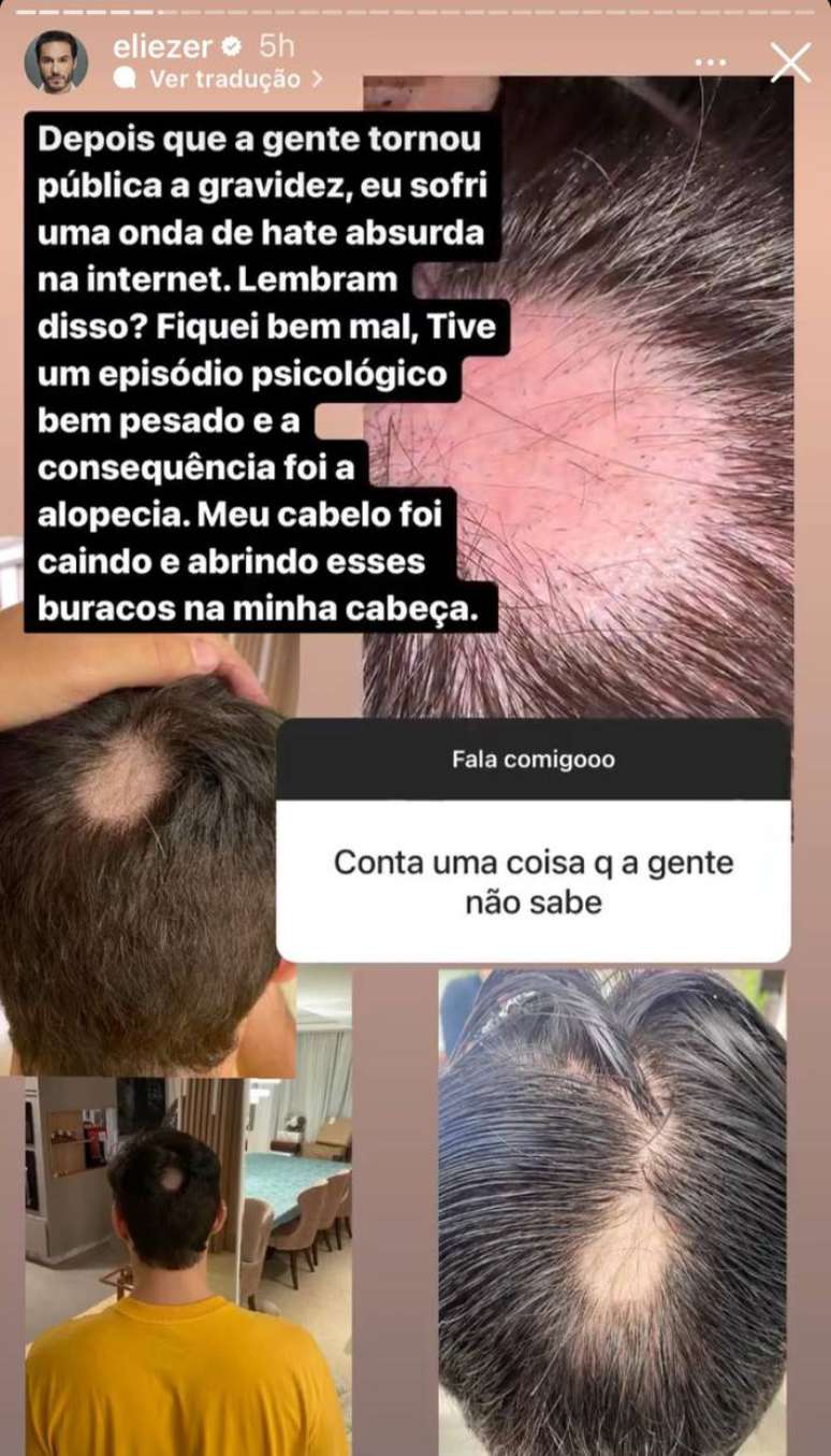 Ex-BBB revela ter sofrido de alopecia após "onda de hate"