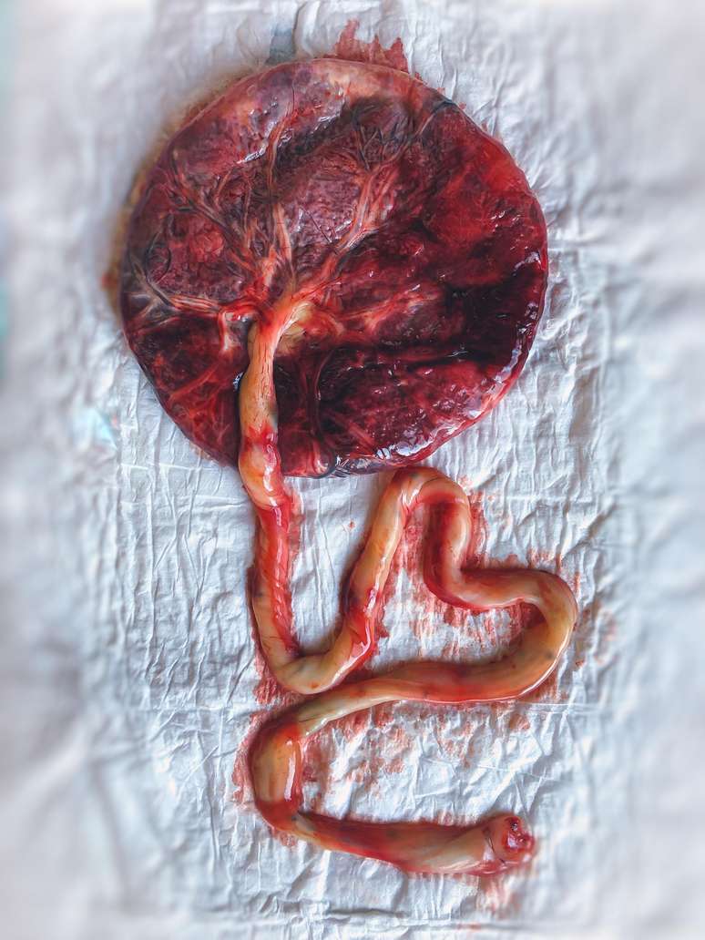 placenta to be stamped