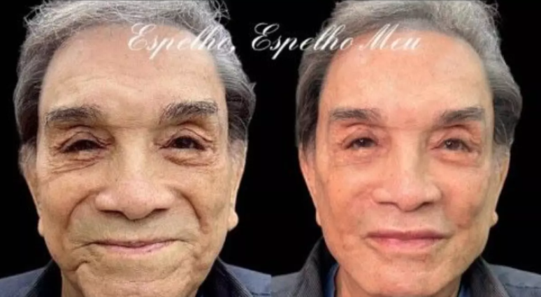 O humorista Dedé Santana, 86 anos, chocou a internet na semana passada ao surgir com o rosto bem diferente