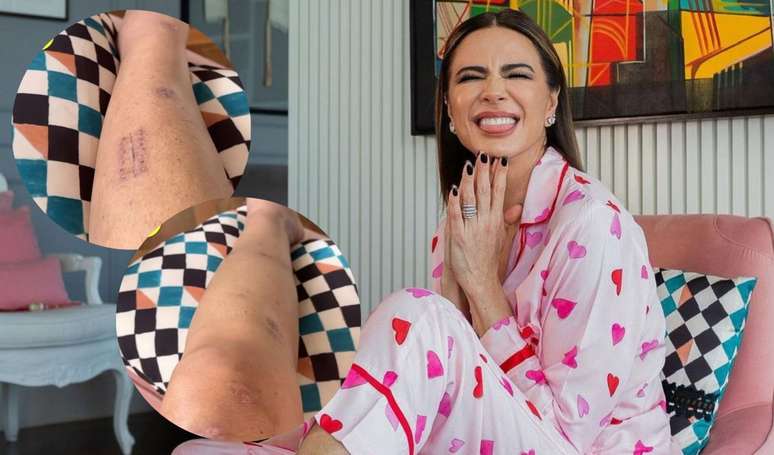 Luciana Gimenez shares leg updates one month after the serious accident she suffered while skiing