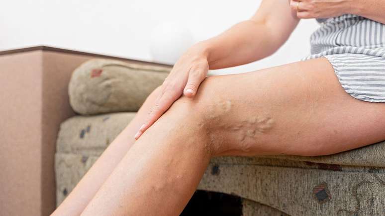 Saiba a diferença entre vasinhos e varizes na pele -