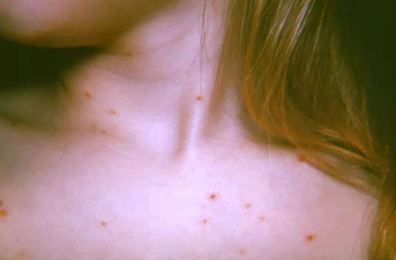 Chicken pox is also caused by a type of herpes virus, but it's different from the infectious agent transmitted by kissing (Image: CDC/KL Herrmann)