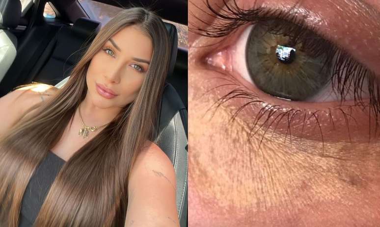 Mulher que tentou camuflar olheiras pode ficar com manchas definitivas -