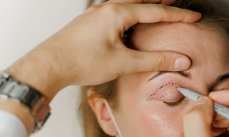 Blefaroplastia: como é o procedimento que rejuvenesce a face -