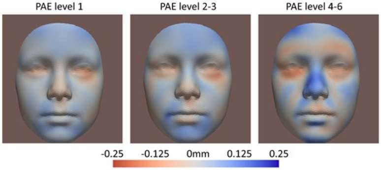 PAE Level 1: crian&ccedil;as expostas a at&eacute; 12g de &aacute;lcool por semana; PAE Level 2-3: crian&ccedil;as expostas a medidas entre 12 e 72g de &aacute;lcool por semana; PAE Level 4&ndash;6: crian&ccedil;as expostas a 12g de &aacute;lcool por dia