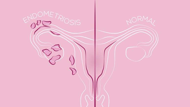 Saiba os principais exames para diagnosticar a endometriose -