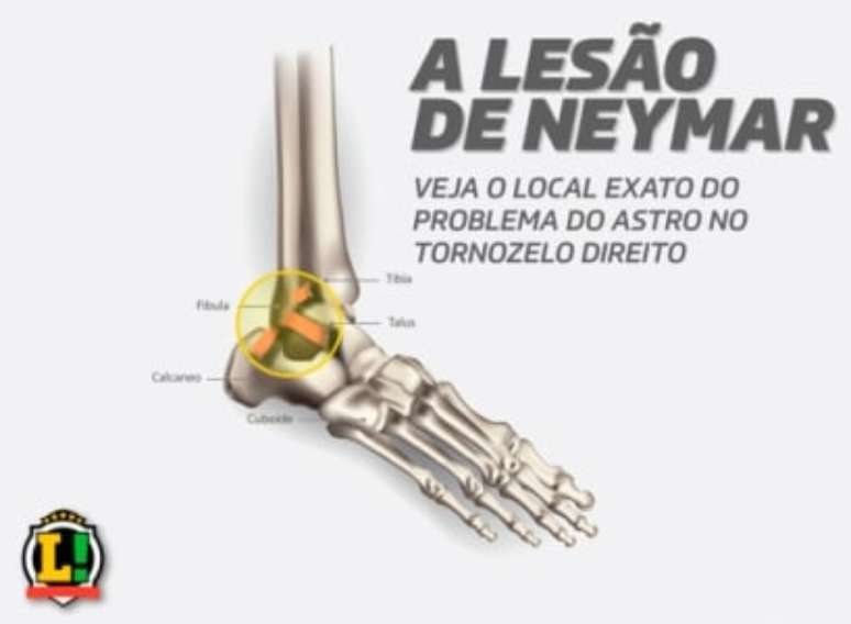 Lesão de Neymar explicada (Foto: Demetrius Almeida / LANCE!)