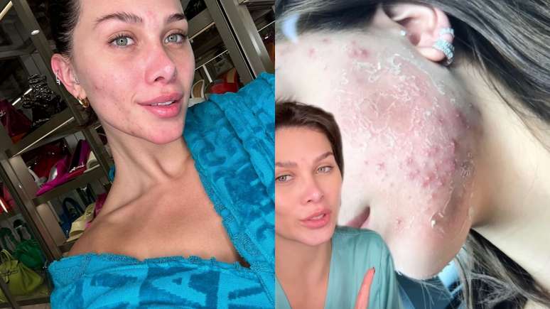 Flavia Pavanelli compartilha sua jornada com problemas de pele: "Não queria ver!"