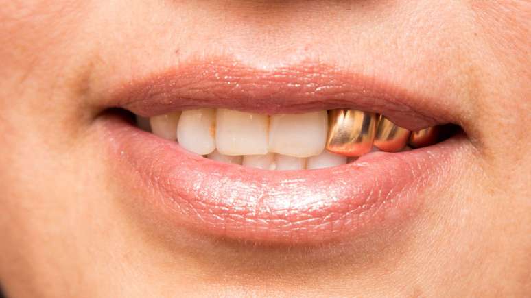 Dentes de ouro exigem cuidado e acompanhamento especializado -