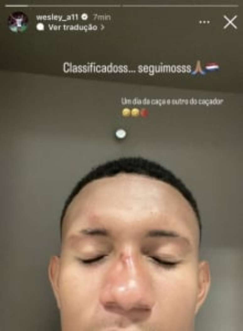 Atacante sofreu lesões no rosto (Foto: Reprodução/ Instagram)