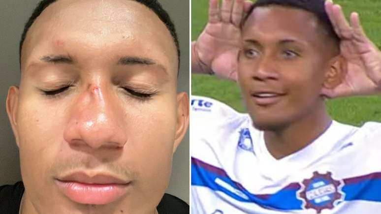 FOTO: Jogador do Caxias fica com nariz 'deformado' após confusão em jogo  contra o Inter