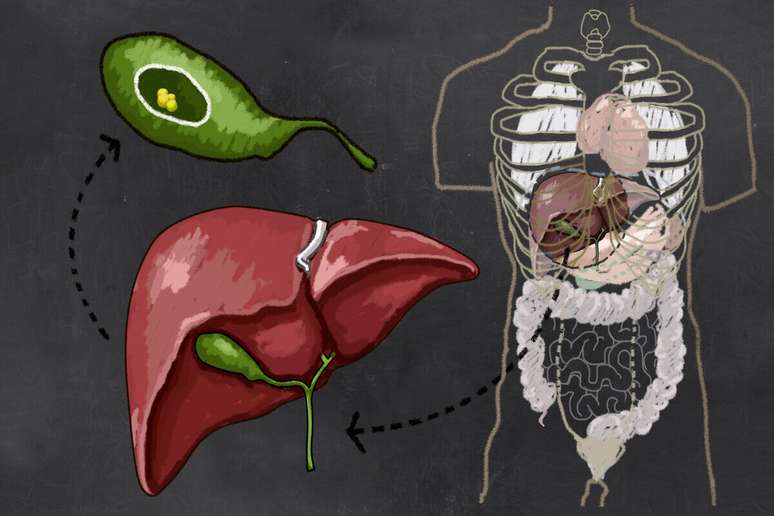 Tratamento para pedra na vesícula pode ser feito via medicamento ou cirurgia 